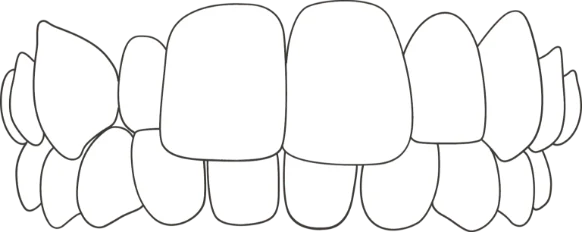 illustration of crossbite