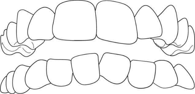 illustration of crowded teeth