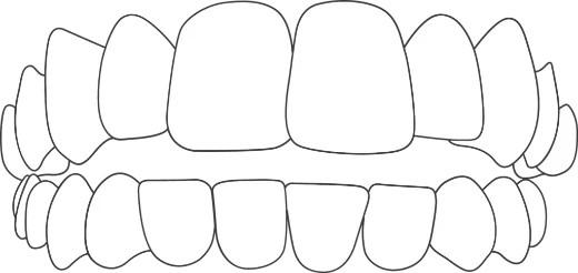 illustration of open bite