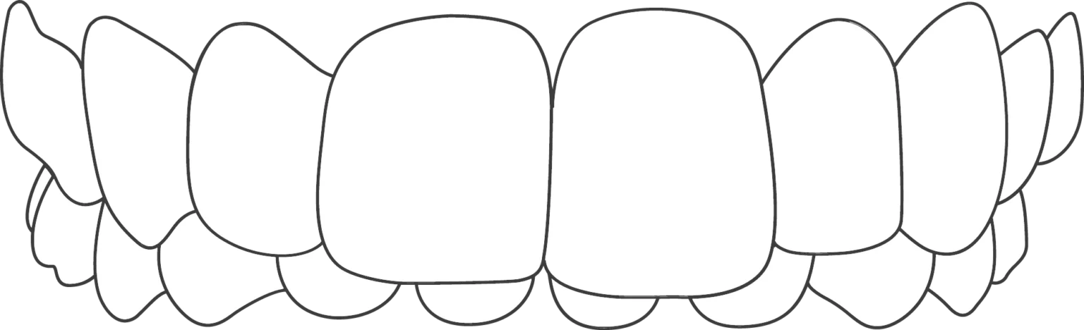 illustration of overbite