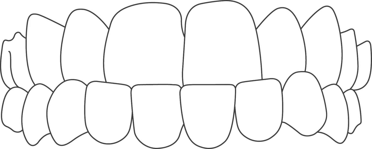 illustration of underbite